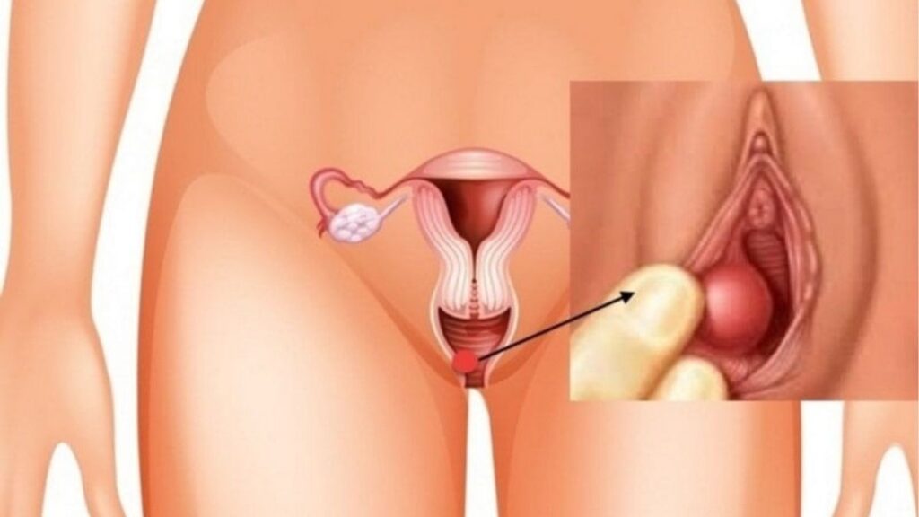 Đau rát khi quan hệ kèm ngứa sưng dịch bất thường và tiểu buốt