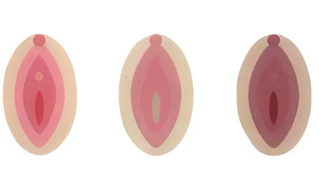 Cách khắc phục cô bé bị thâm an toàn, nên bắt đầu từ đâu? 8 Hormone có thể ảnh hưởng đến sắc tố vùng kín