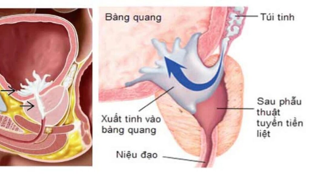 Xuất tinh ngược dòng là gì? Dấu hiệu, nguyên nhân và khi nào cần khám 4 Phân biệt xuất tinh ngược dòng cực khoái khô và không xuất tinh