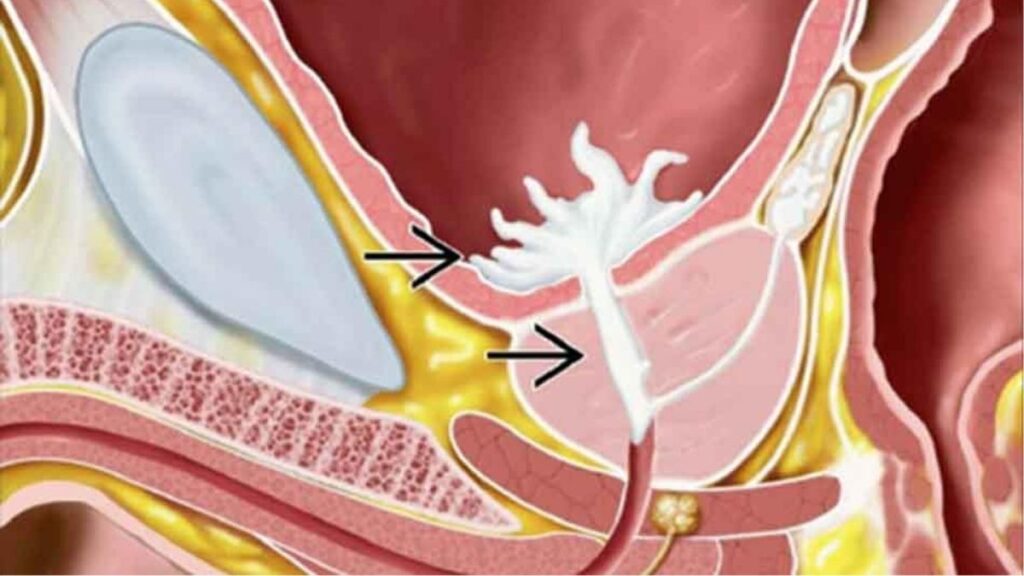 So sánh xuất tinh bình thường và xuất tinh ngược dòng