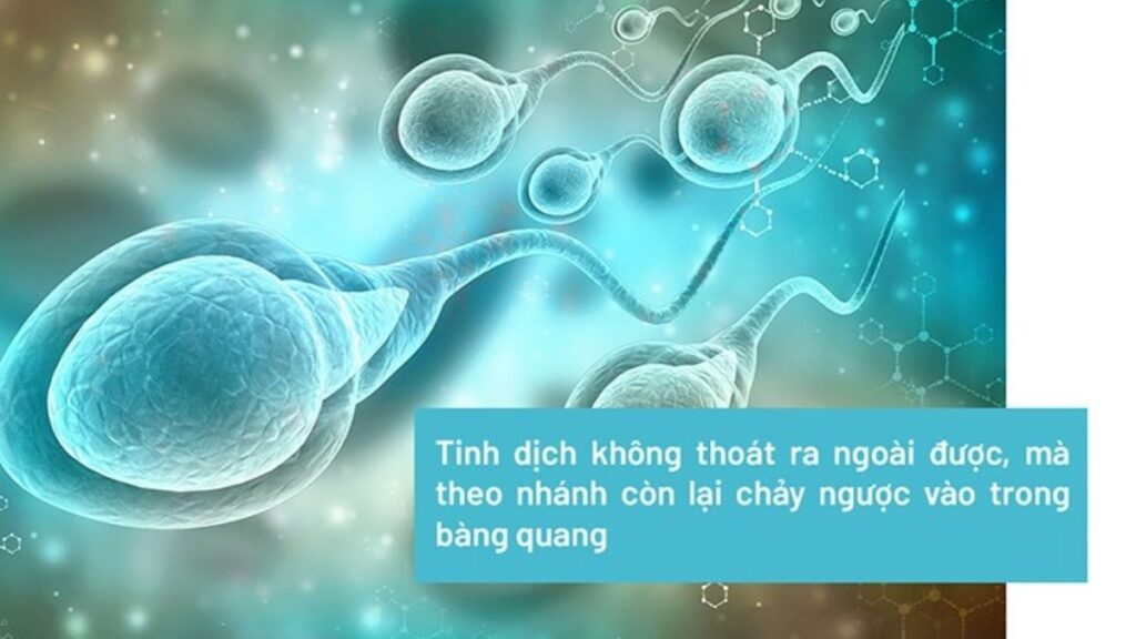 Xuất tinh ngược dòng là gì? Dấu hiệu, nguyên nhân và khi nào cần khám 6 Xuất tinh ngược dòng ảnh hưởng đến khả năng sinh sản ở nam giới