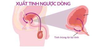 Xuất tinh ngược dòng ở nam giới khi tinh dịch đi vào bàng quang